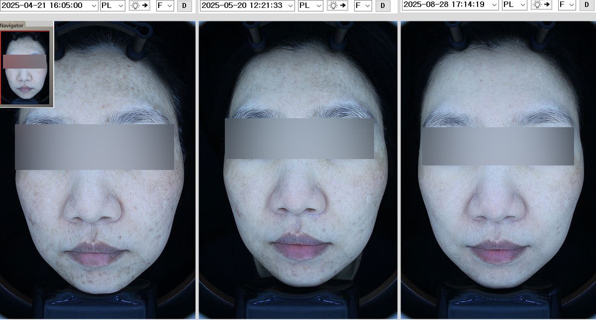 루비레이저