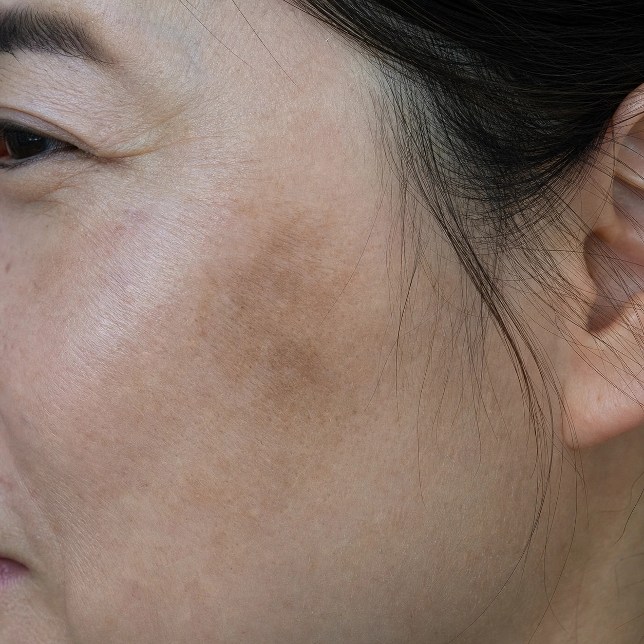 Side view of a cheek and temple showing uneven pigmentation and fine facial hair