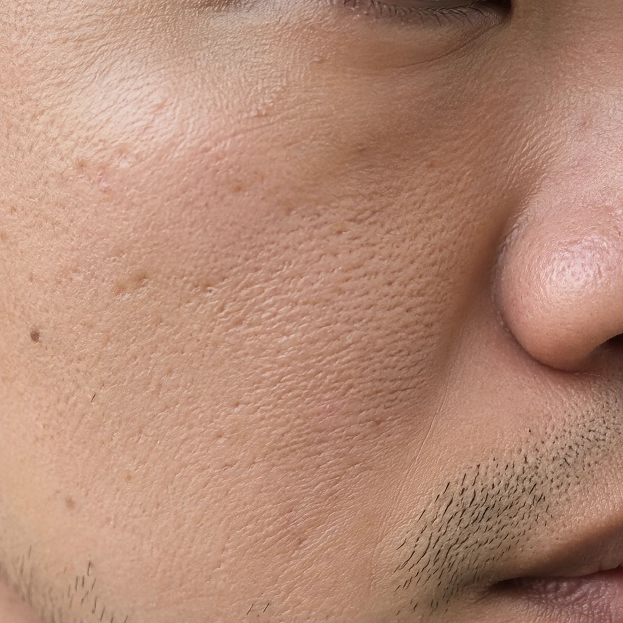 Close-up of a man’s cheek and nose showing irregular pores and short facial stubble