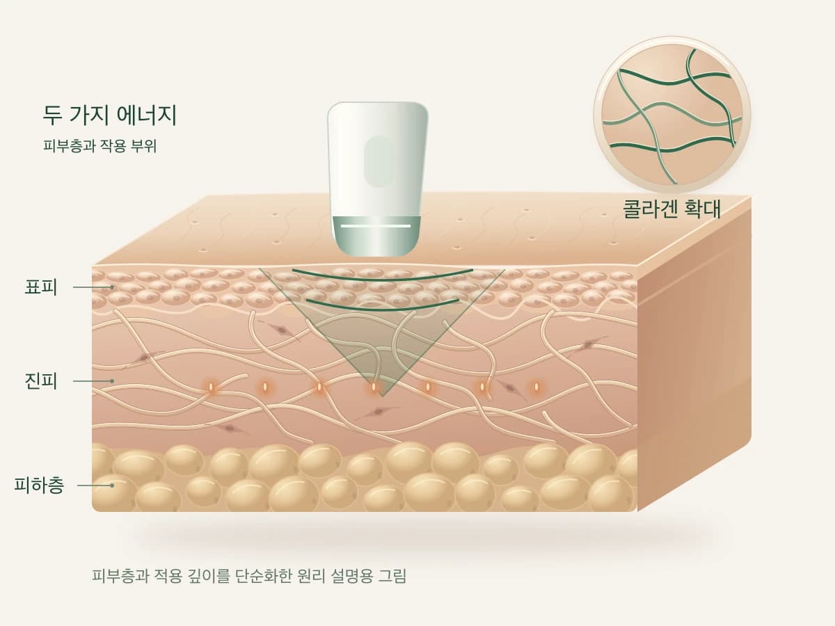 초음파와 고주파가 피부에 적용되는 모습을 그린 피부 단면