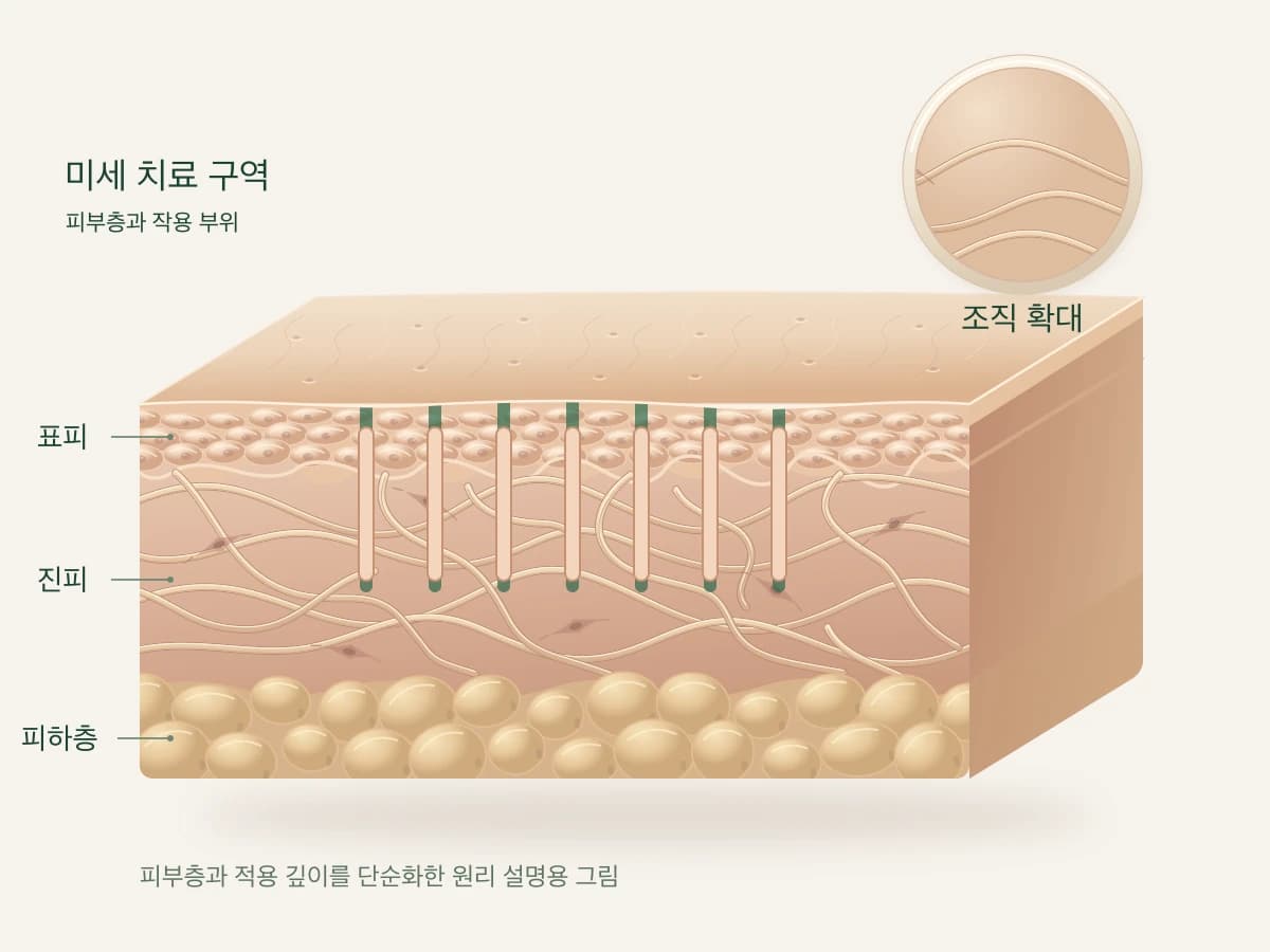 레이저가 피부의 작은 구역에 나뉘어 닿는 모습을 그린 피부 단면