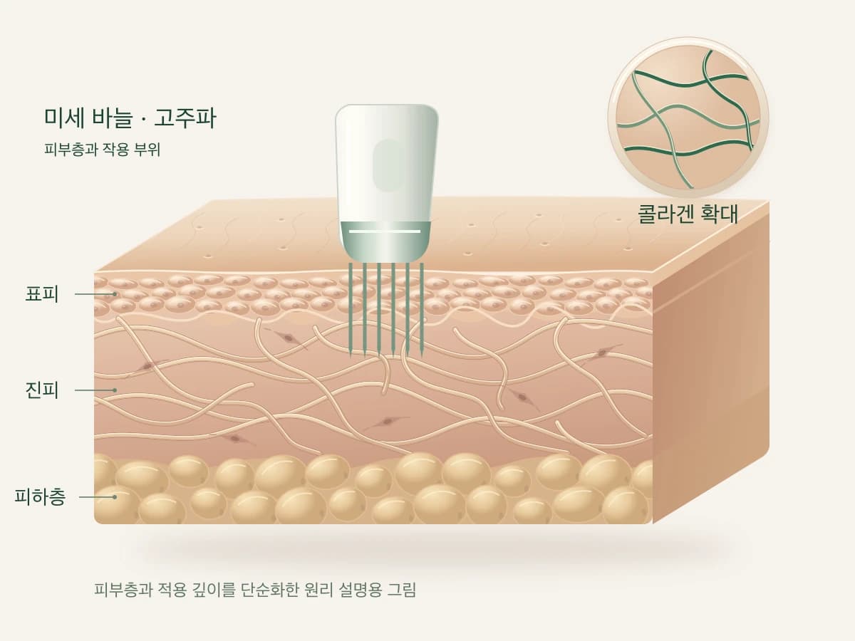 가는 바늘이 피부 안쪽에 닿는 모습을 그린 피부 단면