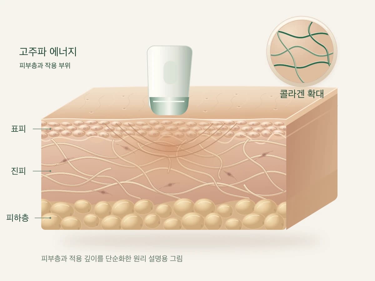 고주파 에너지가 피부 안쪽에 전달되는 모습을 그린 피부 단면