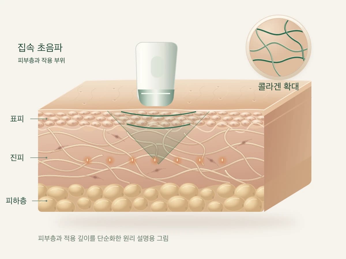 초음파가 피부 안쪽의 선택한 지점에 모이는 모습을 그린 피부 단면