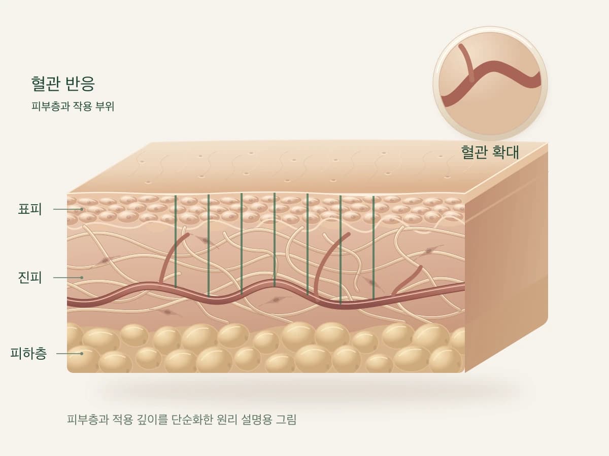 레이저 빛이 피부의 혈관에 닿는 모습을 그린 피부 단면