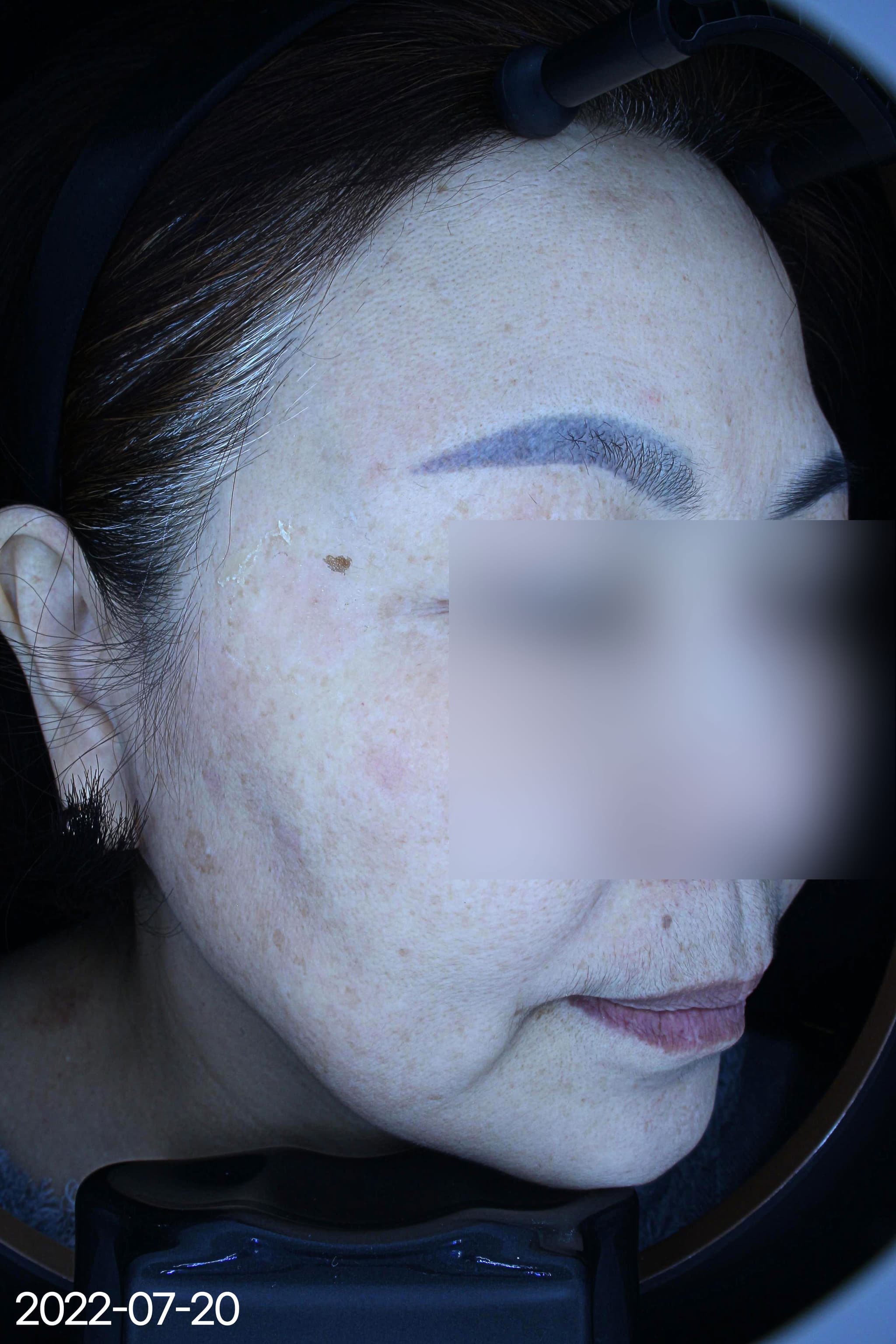 흑자 제거 사례 1 After