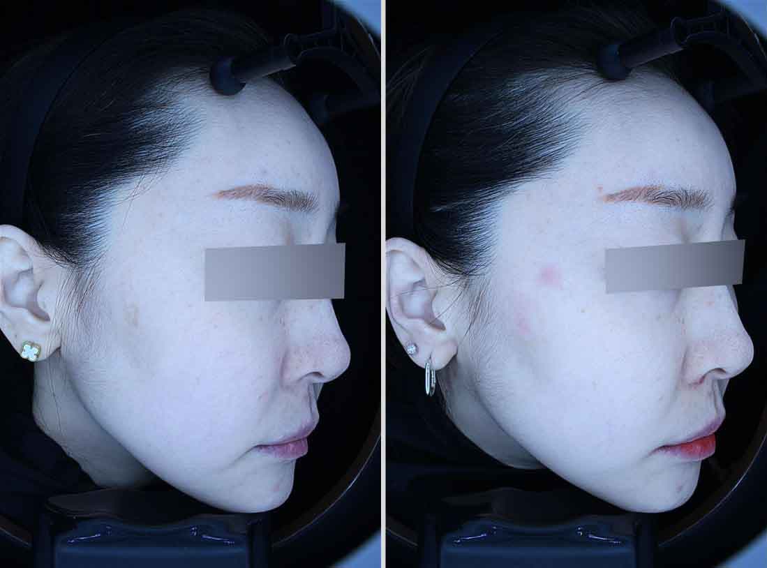 여성 흑자 제거 전후 비교