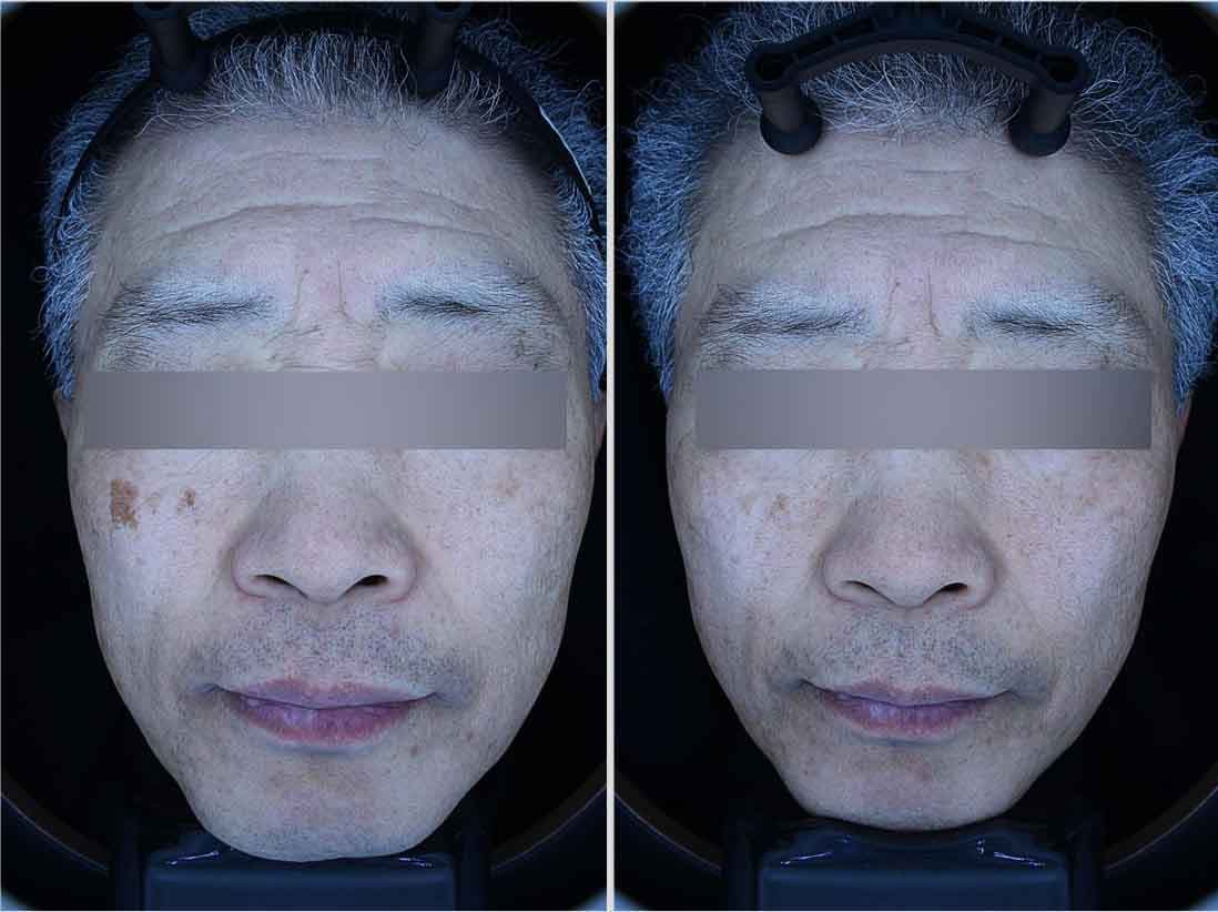 중년 남성 흑자 제거 전후 비교