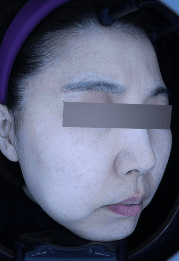 흑자 제거 사례 2 After