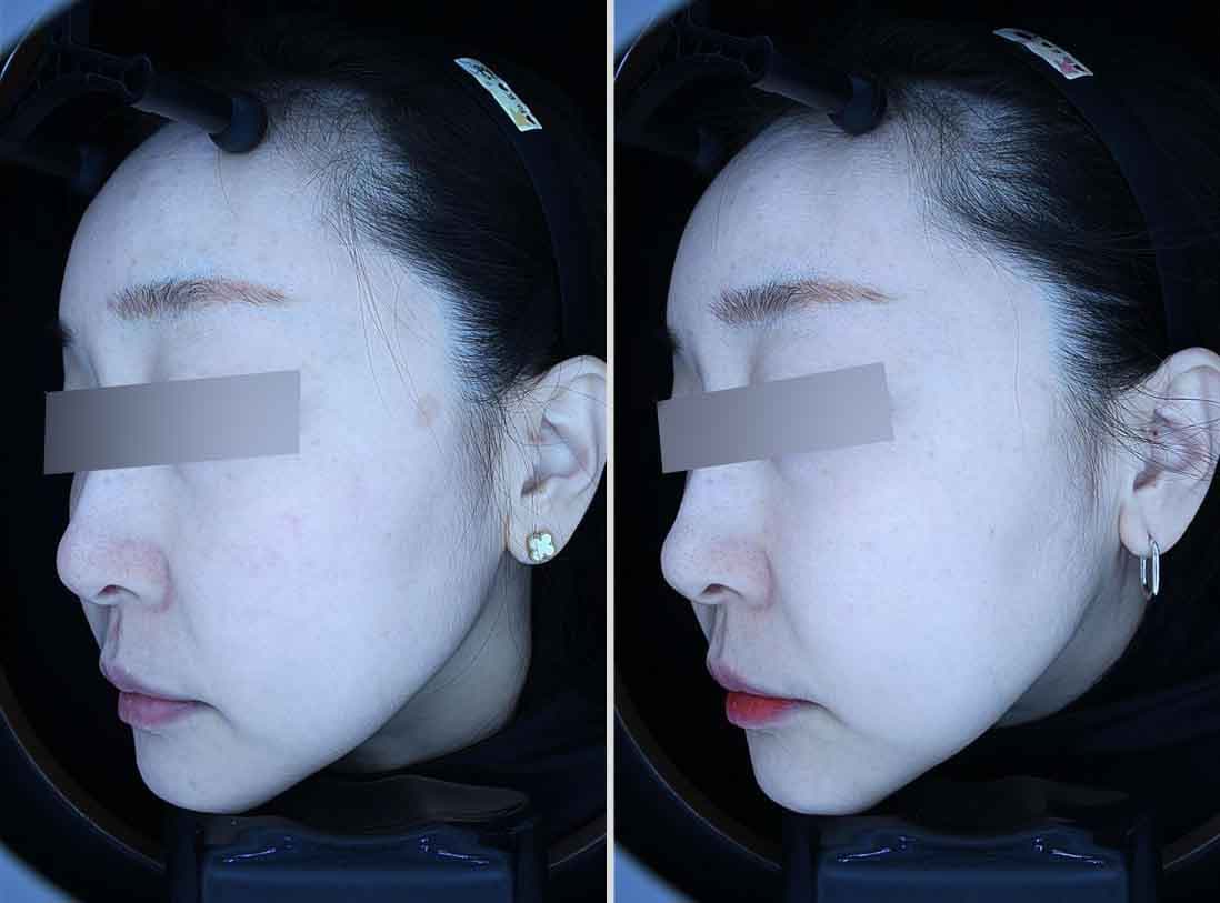 흑자 진료 전후 비교